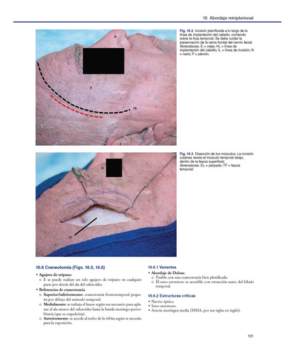 Anatomía Neuroquirúrgica Craneal Operatoria. Incluye E-book