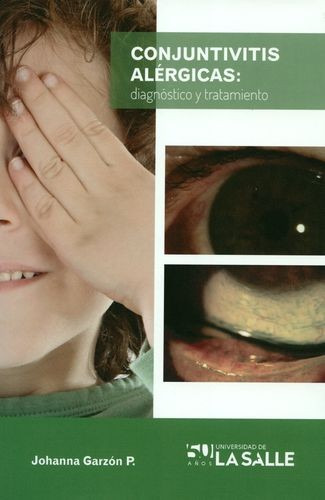 Libro Conjuntivitis Alérgicas: Diagnóstico Y Tratamiento