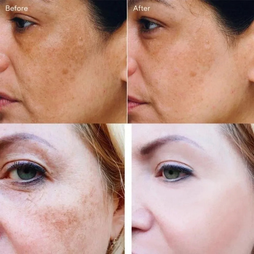 Creme Para Remover Manchas E Manchas De Melasma, Branqueado