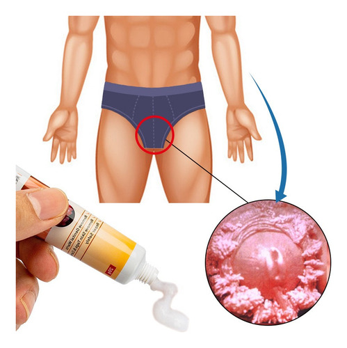2 Un Ungüento Antiverrugas Para Eliminar Verrugas
