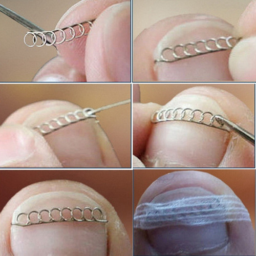 12x Pinzas Encarnadas Para Enderezar Las Uñas De Los Pies C