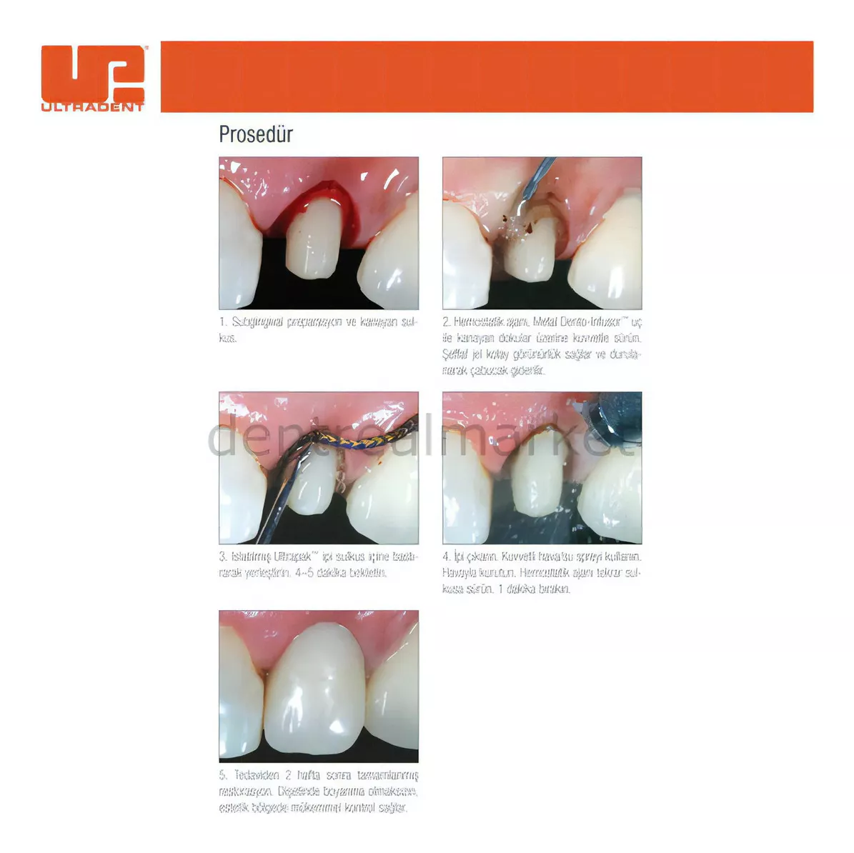 Segunda imagen para búsqueda de jeringas para anestesia dental