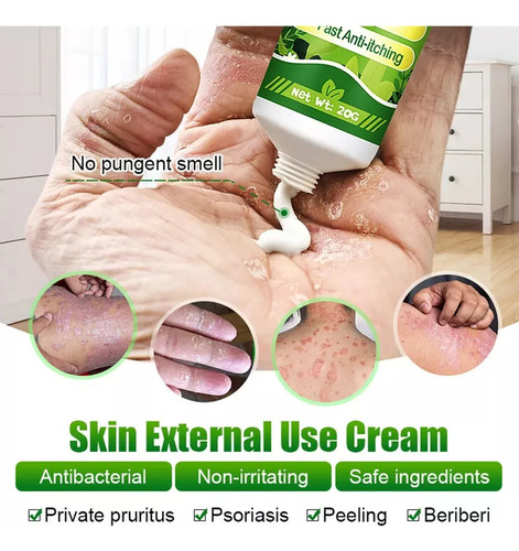Creme De Psoríase Xinnuuo Para Eliminar Musgo 20g* 2uds