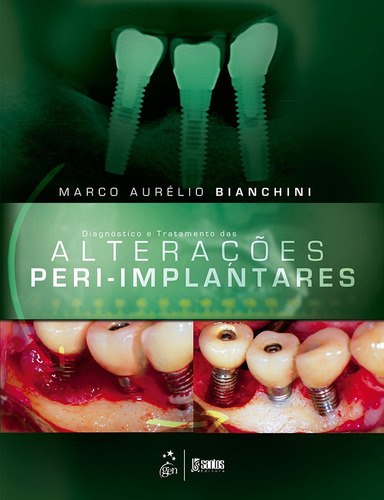 Diagnóstico e Tratamento das Alterações Peri-Implantares, de Bianchini. Livraria Santos Editora Comércio e Importação Ltda., capa mole em português, 2014