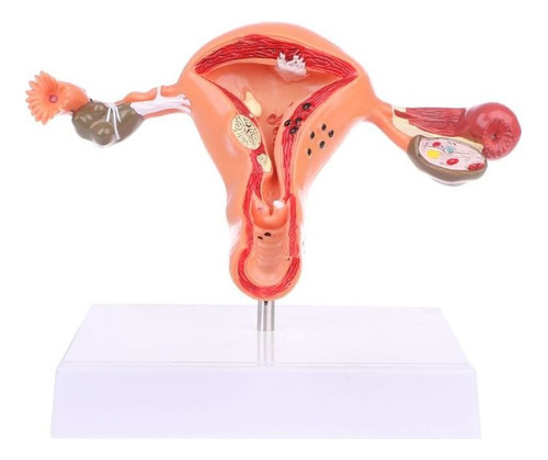 Modelo Anatómico Del Ovario Del Útero Patológico Anatomía Cr