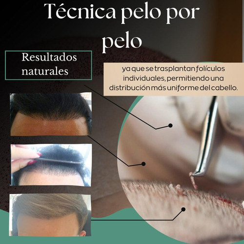 Implante Capilar Pelo X Pelo Calvicie Entradas Hombres