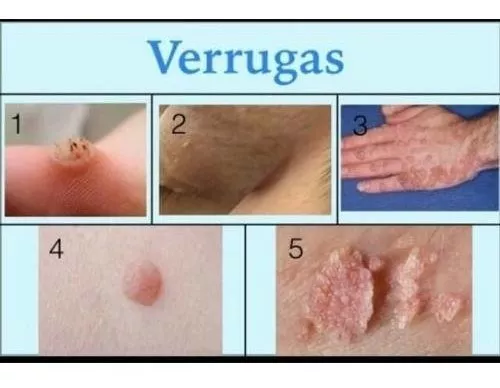 hpv and herpes)