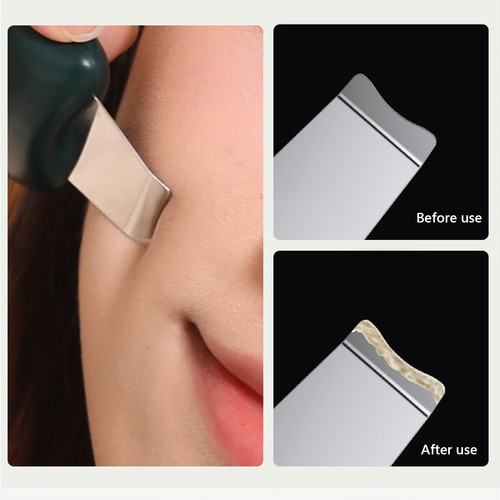 Espátula Portátil F Para Espinillas Y Espátula Facial 1001