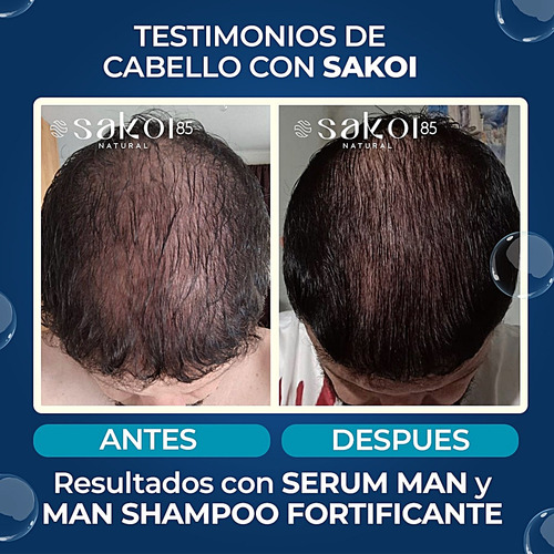 Shampoo Alopecia Androgenetica Para Hombre Y Serum Set 2pz