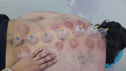 Imagem 1 de 1 de Ventosaterapia