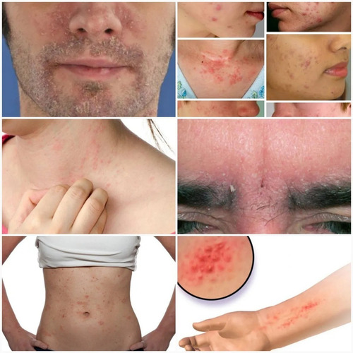 Jabon Para Psoriasis, Caspa En La Piel, Ácaros, Alergias