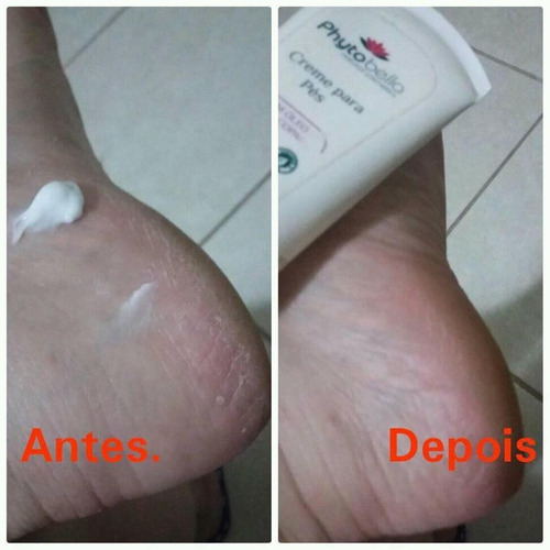 Creme Para Pés Descascando E Ressecados Hidratante Com Uréia