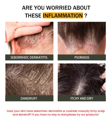 2 Piezas De Crema Para La Dermatitis Seborreica