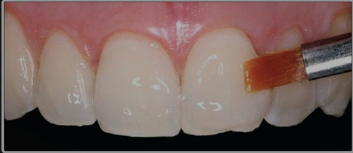 Limpieza Dental Niños Hasta 12 Años Y Topicación Con Flúor.