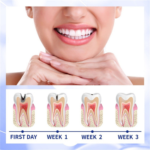 V Repair Caries Blanquea Los Dientes Caries Placa Caries Fre