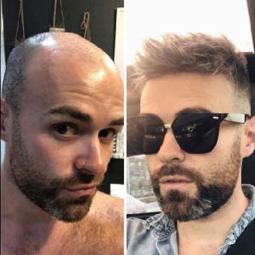 Imagem 1 de 1 de Acabe Com A Calvice Já!