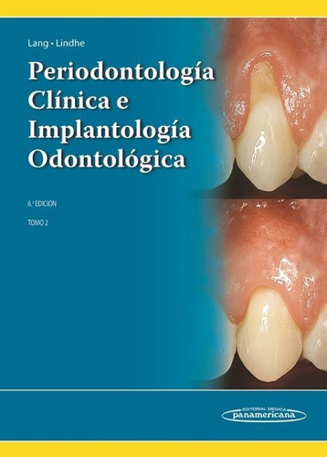 Libro Lindhe:periodontologã¿a Clã¿nica 6a Ed. T2