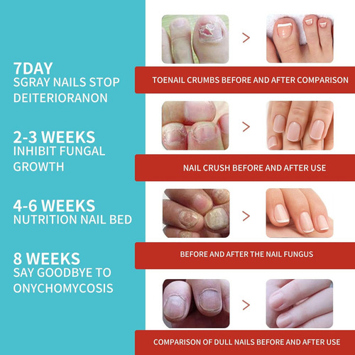 16 Parches De Uñas Para Hongos Tratamiento Onicomicosis