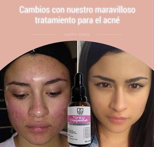 Tónico Despigmentante Quita Manchas, Acné, Pecas, Aclarante