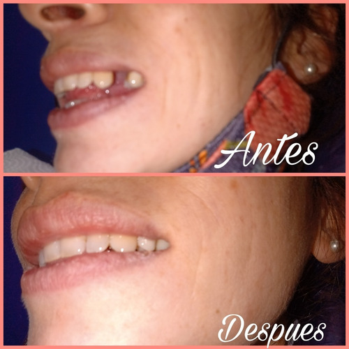 Arañitas Dentales En El Momento ,prótesis Dentales