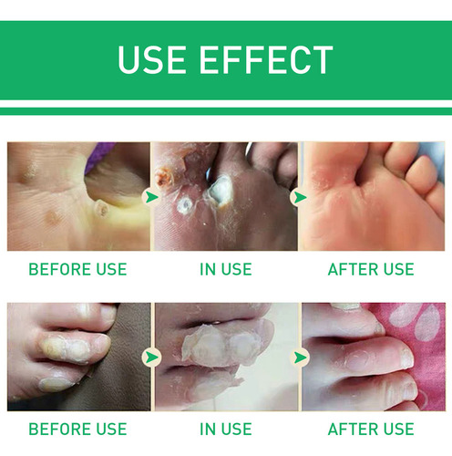 Solución Para Verrugas Y Ojos De Pollo De 10 Ml, 2 Piezas Pa
