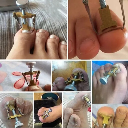 Corrector De Uñas Encarnadas Endereza Corrige Uñero
