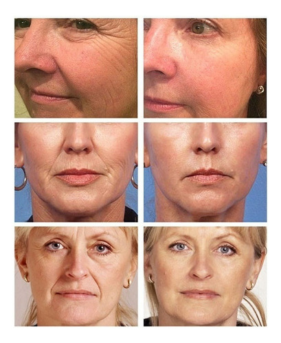 Creme Retinol Remove Rugas Linhas Finas Clareamento
