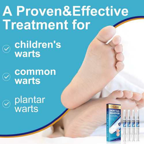Caneta De Remoção De Verrugas Para Remover Caneta Para