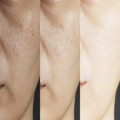 Imagen 6 de 7 de Gel Mandelico Para Manchas Marcas Cicatrices De Acne Idraet