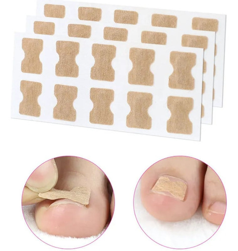 Kit 30 Adesivos Órtose Correção De Unhas Encravadas