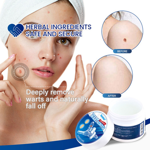2×crema For Eliminar Verrugas Y Lunares Natural Creative