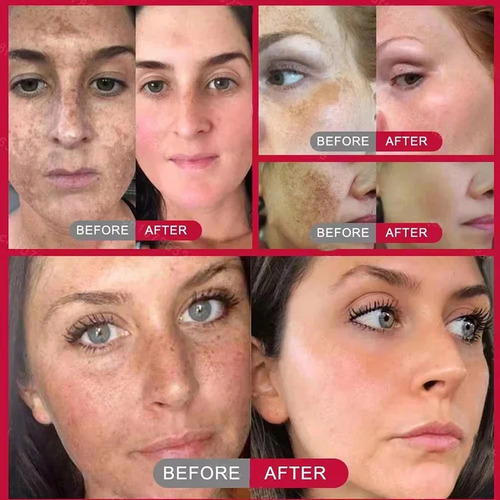 Crema Facial Blanqueadora Para Eliminar Pecas, Melasma Oscur