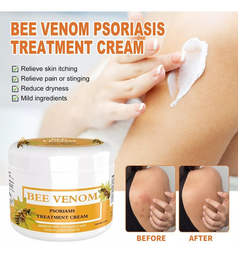5×crema Para Tratamientos Psoriasis Con Venenos Abeja