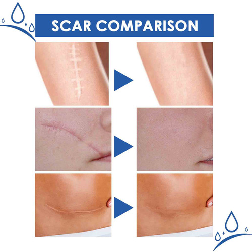 Fastest Removing And Scar Removing Cream Scar Gel Bruise Rep