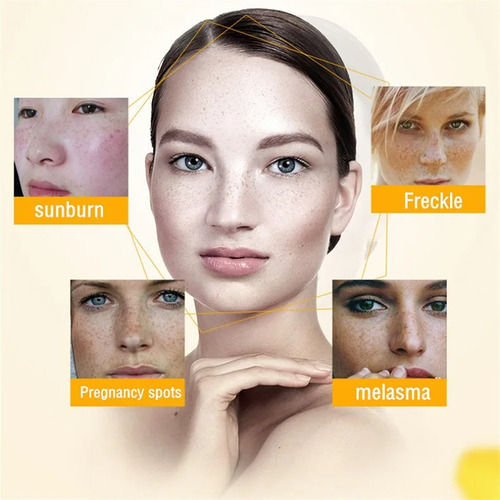 Creme Clareador De Sardas Para Remover Manchas Escuras