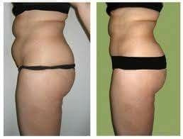 Maderoterapia Copasueca+rodillo+tabla+facial Pack 5x$38000