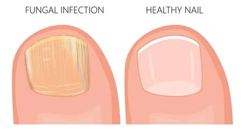 Serum Antihongos Para Uñas - Cura Manos Y Pies 100 Ml Neutra