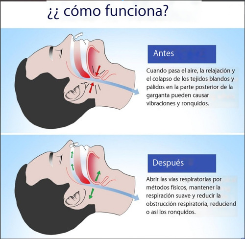 12 Clips Dilatador Nasal Anti Ronquidos Ayuda A Dejar Roncar Facilita Respira