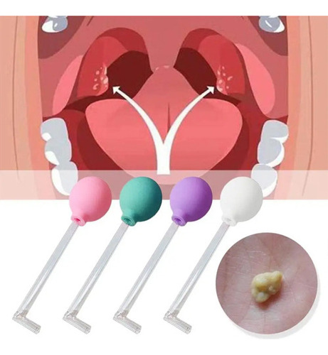 Ferramenta De Remoção De Pedras Tonsil Cleaner De Vidro