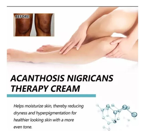 Creme Novo Fixderma Nigrifix Para Acantose Nigricans Fbg