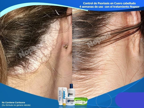 Nopsor Jab Sol, Más Suave, Pepepsor, Shampo Aux Tx Psoriasis