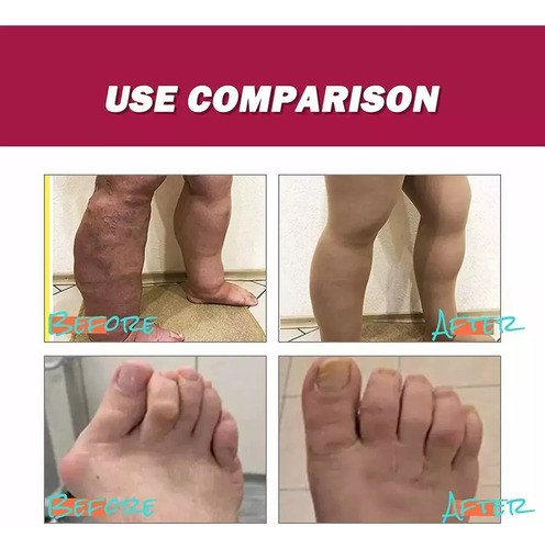 Para Pomadas Para Tratar La Artritis Muscular De La Rodilla