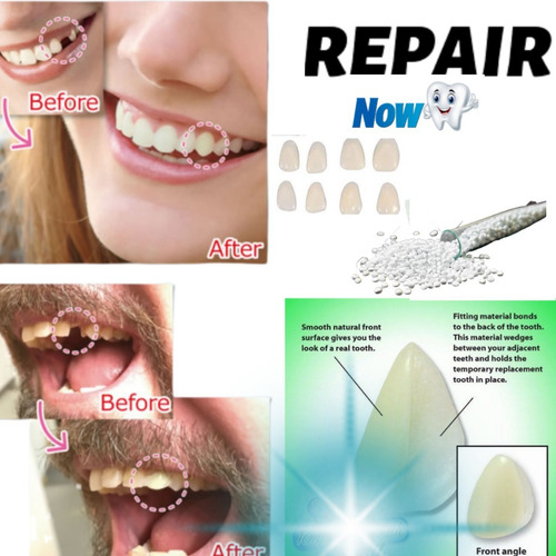 Imagen 4 de 6 de Kit Dentadura Provisoria Postiza Cosmética Agnovedades