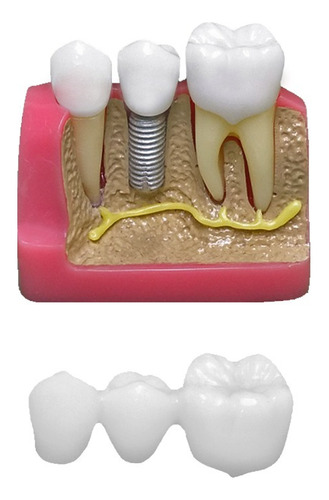 Macro Modelo Ponte Fixa 3 Elementos E 1 Implante Com Núcleo