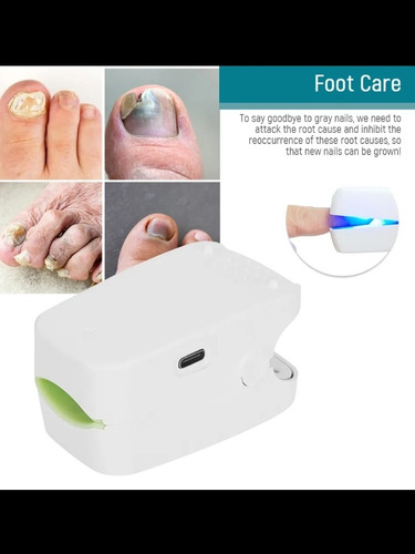 Láser Eliminación Para Hongos Uñas (onicomicosis)