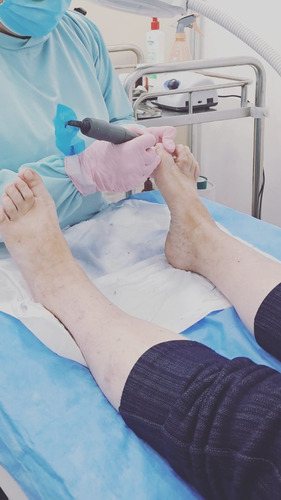 Podología, Pie Diabético, Uña Incarnada, Micosis (hongos)