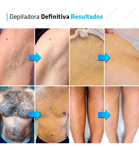 Maquina Depilacion Definitiva Laser Diodo Adss Premium Negro