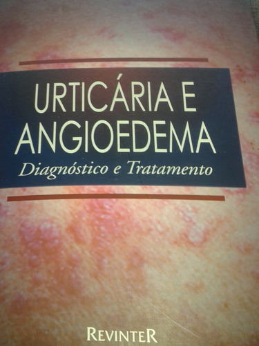 Urticária E Angiodema - Diagnóstico E Tratamento