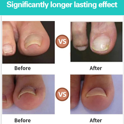 Parche Corrector De Uñas Para Cuidado Perfecto