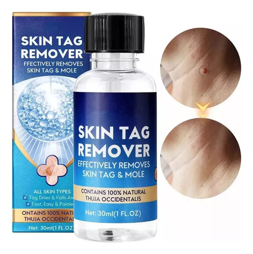 Nitrógeno Líquido Antiwart, Eliminador De Moho